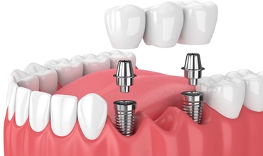 Best Dental Implant Fixing Clinic in Greater Noida