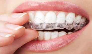 Best Invisible/Clear Braces Clinic in Greater Noida