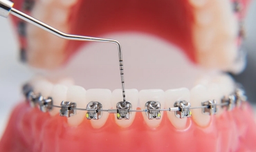 Braces Adjustment Clinic in Greater Noida