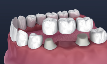 Ceramic Crowns and Bridges Fixing Clinic in Greater Noida