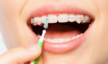Ceramic Dental Braces Clinic in Greater Noida