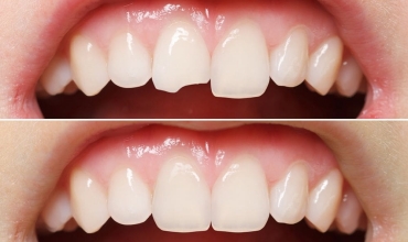 Composite Bondings Clinic in Greater Noida