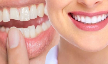 Cosmetic Veneers Bonding Clinic in Greater Noida