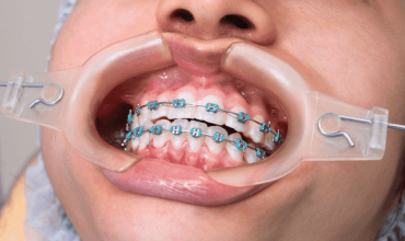 Dental Braces Fixing Clinic in Greater Noida