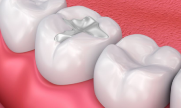 Dental Fillings in Greater Noida