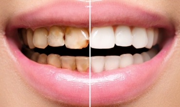 Dental Restoration Clinic in Greater Noida