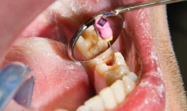 Endo Surgery Or Apicoectomy Clinic in Greater Noida