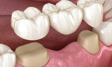 Fixed Partial Denture FPD Clinic in Greater Noida