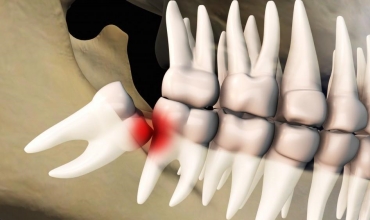 Impaction Impacted Tooth Extraction Clinic in Greater Noida 