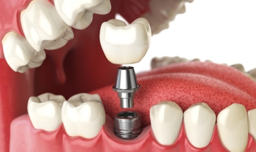 Implant Prosthesis Clinic in Greater Noida