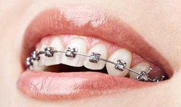Metal Braces Fixing Clinic in Greater Noida