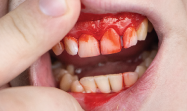 Mouth Bleed Clinic in Greater Noida