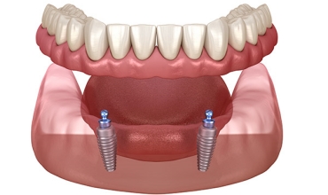 Overdentures Fixing Clinic in Greater Noida