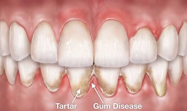 Periodontal Flap Surgery Clinic in Greater Noida