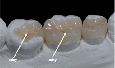 Porcelain inlays and onlays Clinic in Greater Noida