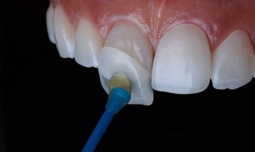 Porcelain Veneers Clinic in Greater Noida