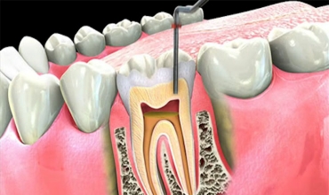 RCT  Root Canal Treatment Clinic in Greater Noida