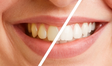 Scaling  Polishing Clinic in Greater Noida