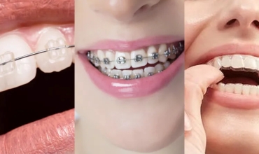 Straightening Teeth Conventional Braces Clinic in Greater Noida