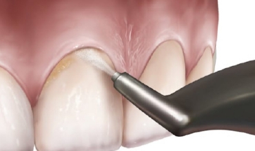 Tooth Air Polishing Clinic in Greater Noida