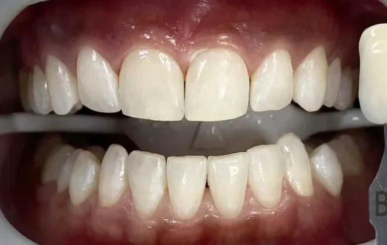 1-Whitening-After-900x570-1