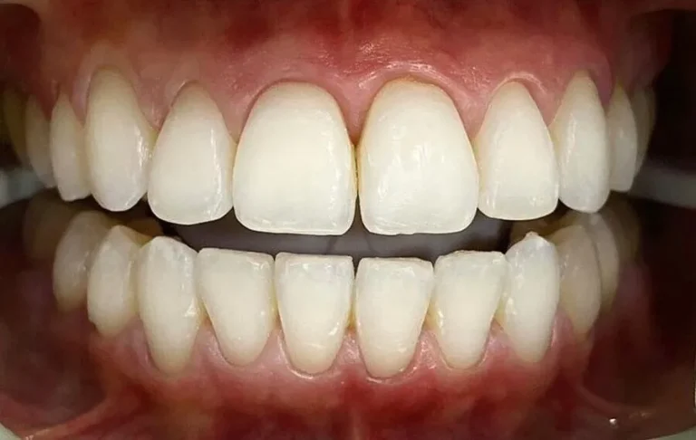 2-Whitening-After-900x570-1