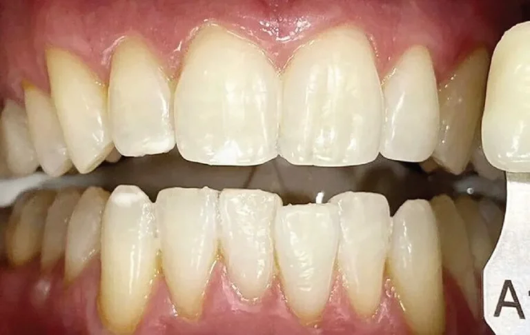 3-Whitening-After-900x570-1