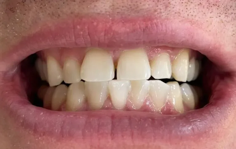 4-Whitening-After-900x570-1